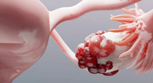 Çikolata Kisti Tedavisi