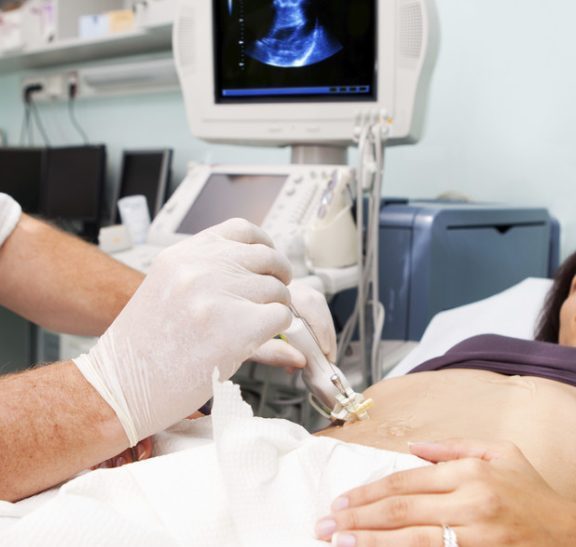 Kapalı Yumurtalık Kist Ameliyatı