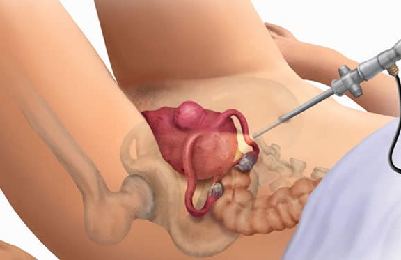 Kapalı Rahim Ameliyatı