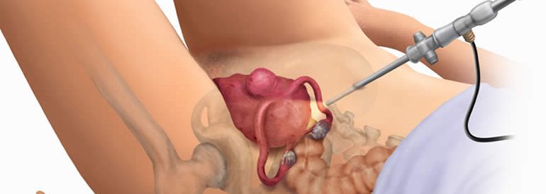 Kapalı Rahim Ameliyatı