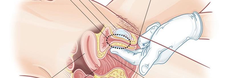 G Noktası Büyütme