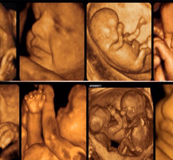 Dört Boyutlu Ultrason