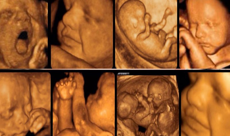 Dört Boyutlu Ultrason