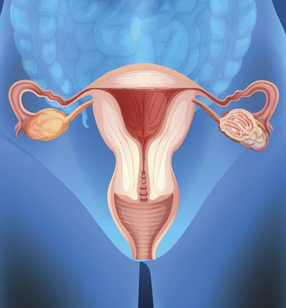 Yumurtalık Kist Tedavisi