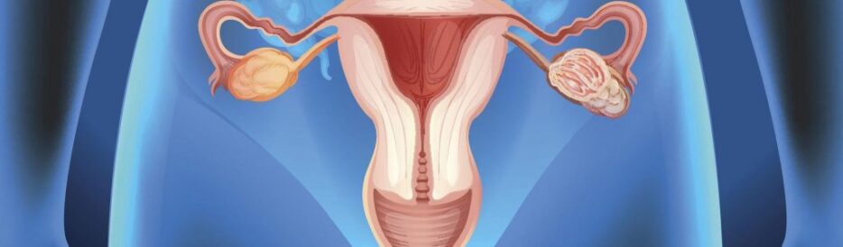 Yumurtalık Kist Tedavisi